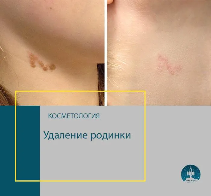 До и после процедуры