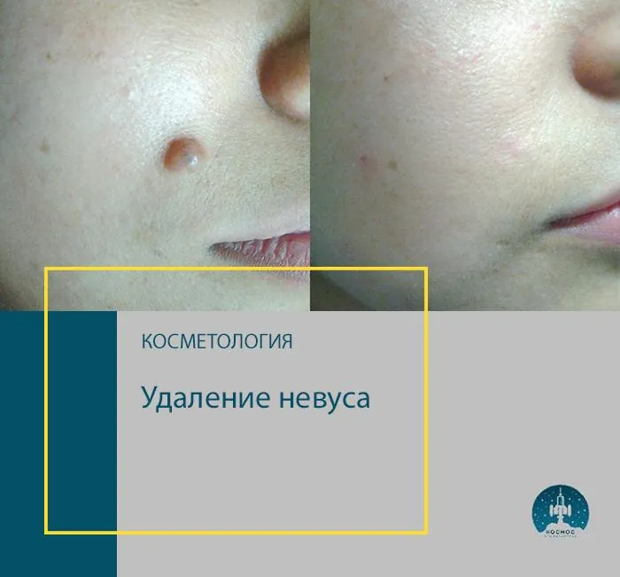 До и после процедуры
