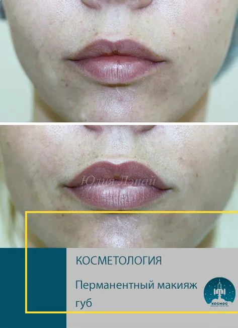 До и после процедуры